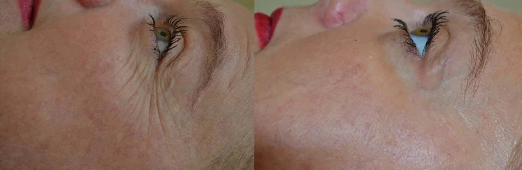 Radiance Wheaton Laser & Medspa Blog