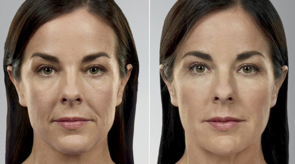 before and after juvederm and voluma copy