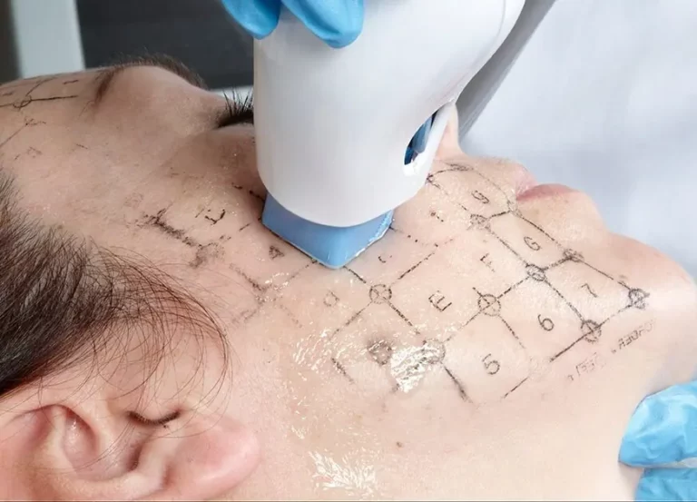 Radiance Wheaton Laser & Medspa Thermage